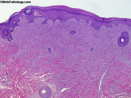 Scrotum_Granular Cell Tumor1.jpg